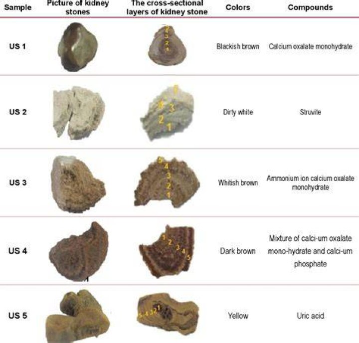 Are kidney stones black?