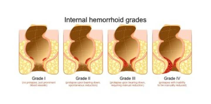 Are thrombosed hemorrhoids painful?