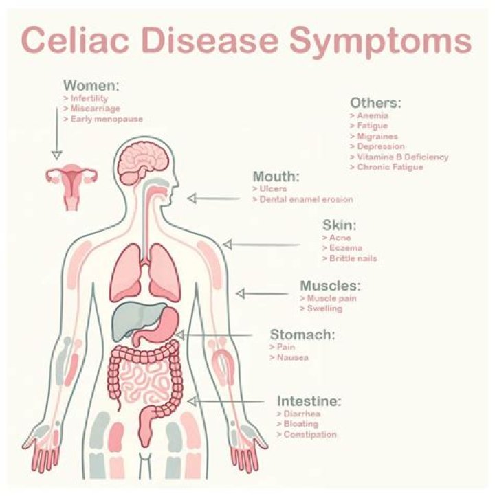 Can celiac disease come on suddenly?