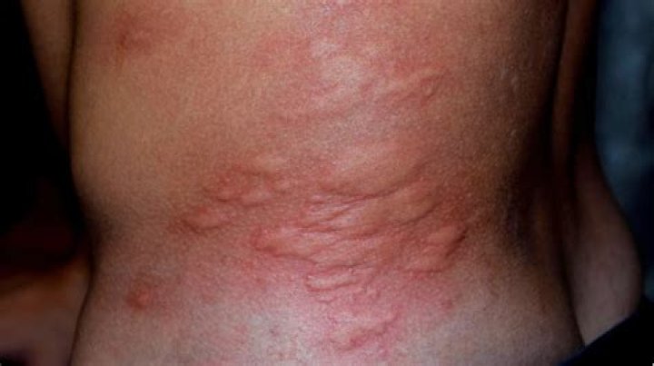 Can cholinergic urticaria get worse?