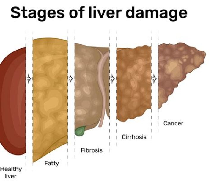 Can liver scarring be reversed?
