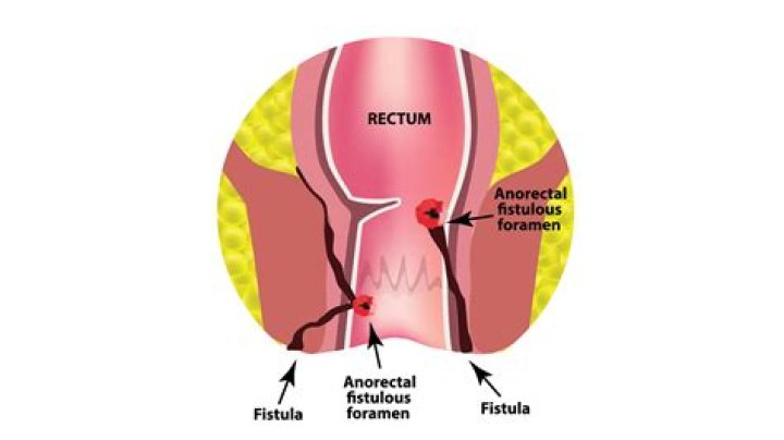 Can obstetric fistula be cured?