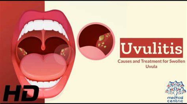 Can you have two uvulas?