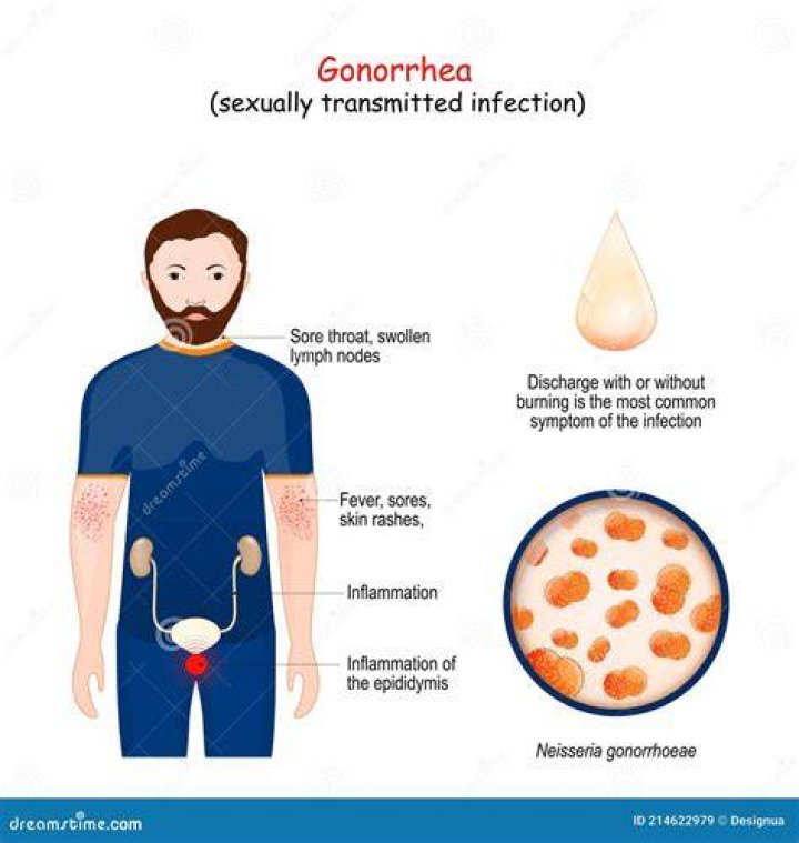 Could you have gonorrhea?