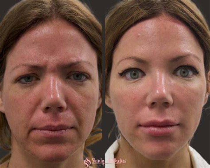 Does cheek filler hurt?