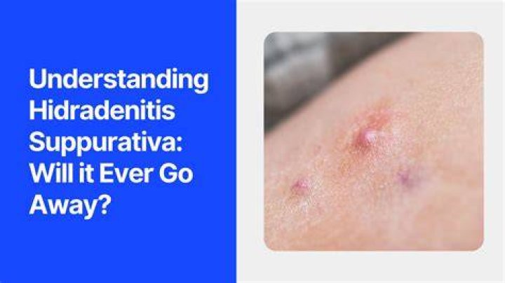 Does hidradenitis suppurativa go away?