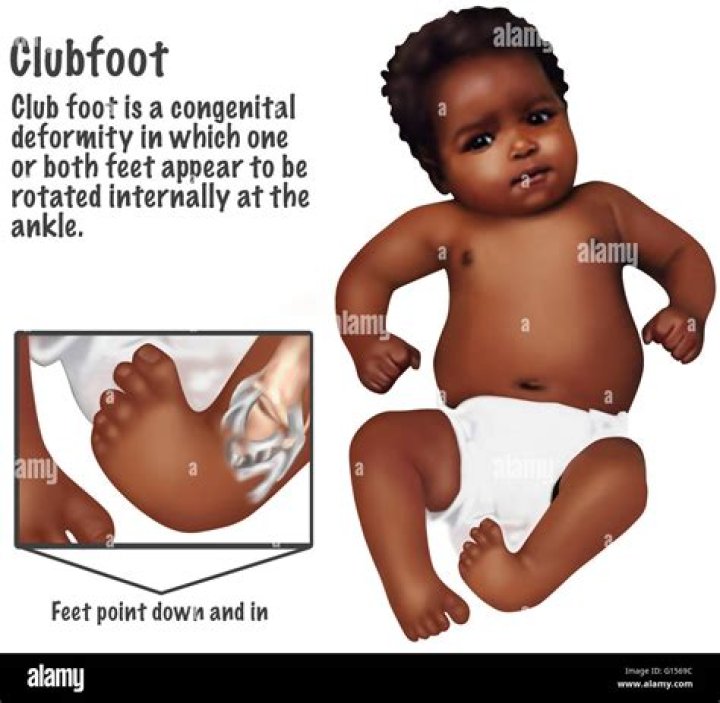 How do babies get clubfoot?