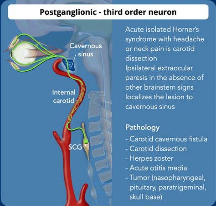 How does horner's syndrome occur?