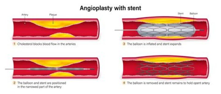 How to do angioplasty surgery?