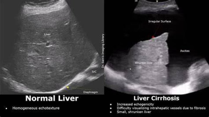 Is coarse liver reversible?