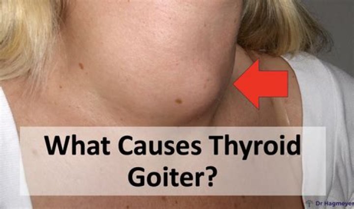 Is goitre an infectious disease?