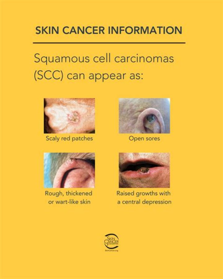 Is scc cancer dangerous?