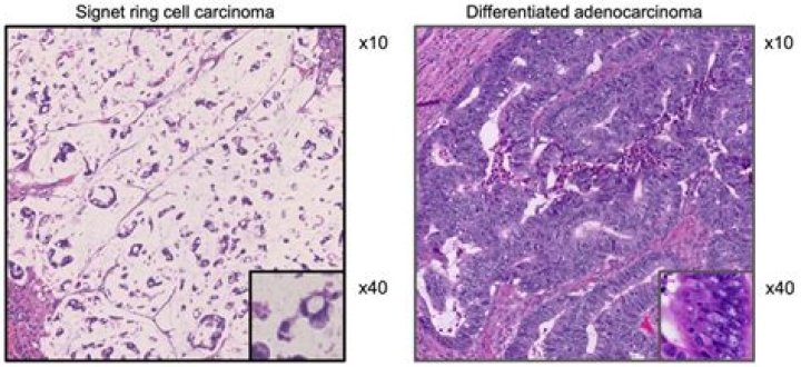 Is signet ring cell carcinoma hereditary?