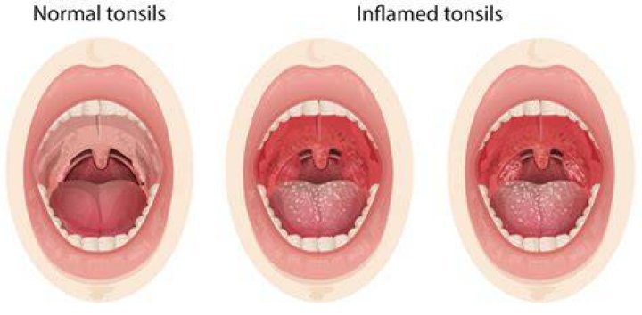 Should throat feel lumpy?