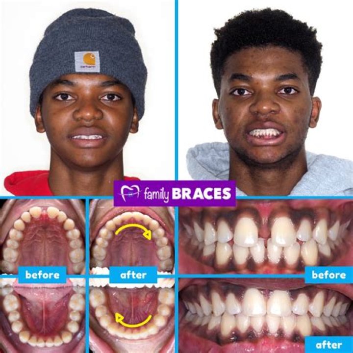 What does the word gap-toothed mean?