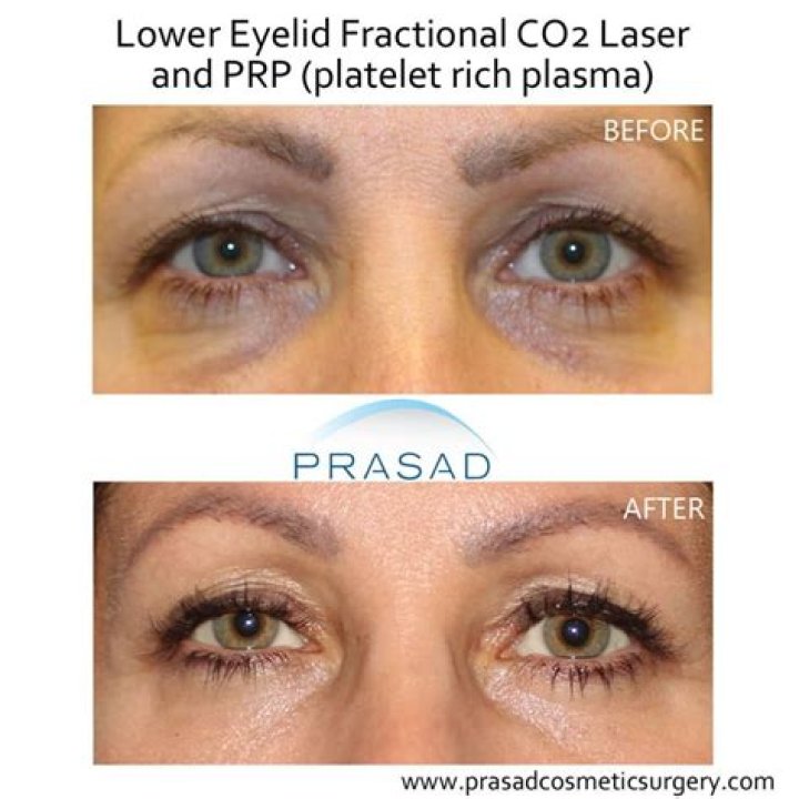 What injectable is used for under eyes?
