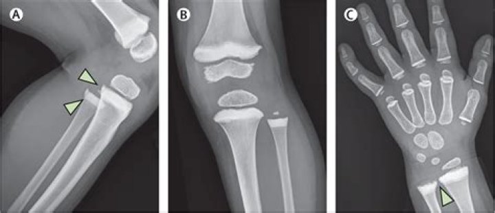 What is metaphyseal sclerosis?