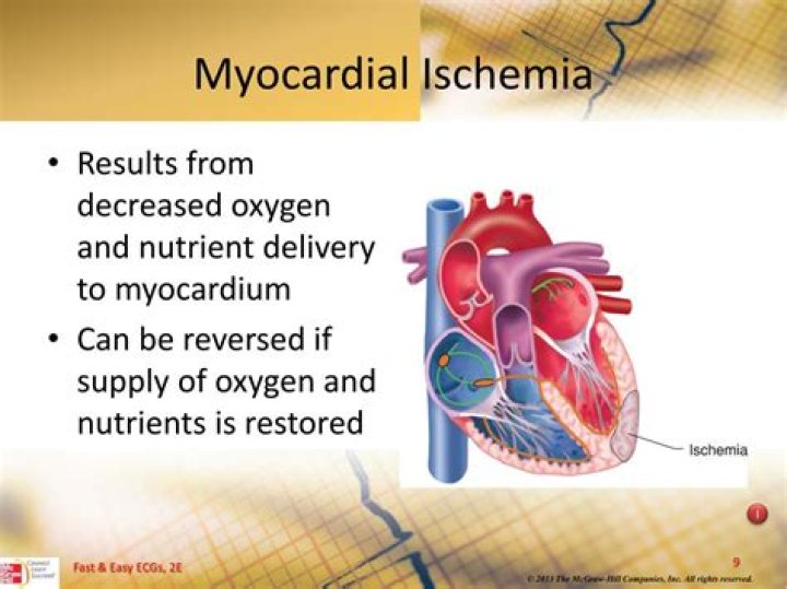 What is myocardial ischemia?