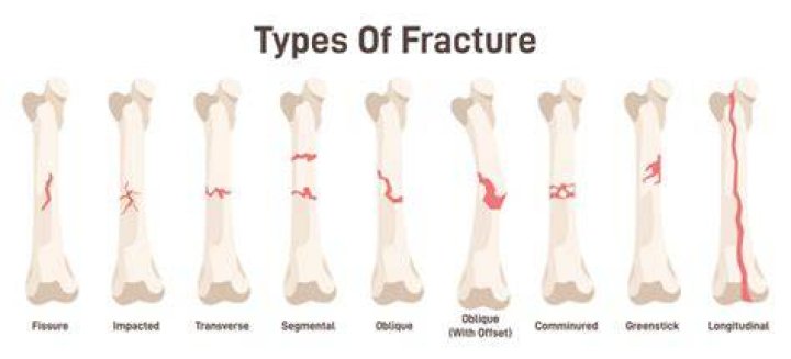 When does impacted fracture occur?