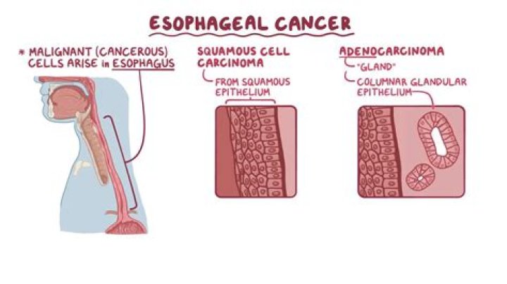 Which organ does esophageal cancer affect?