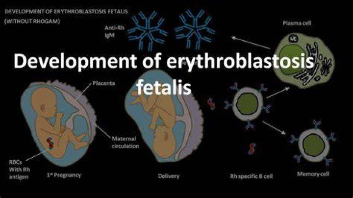 Who does erythroblastosis fetalis affect?